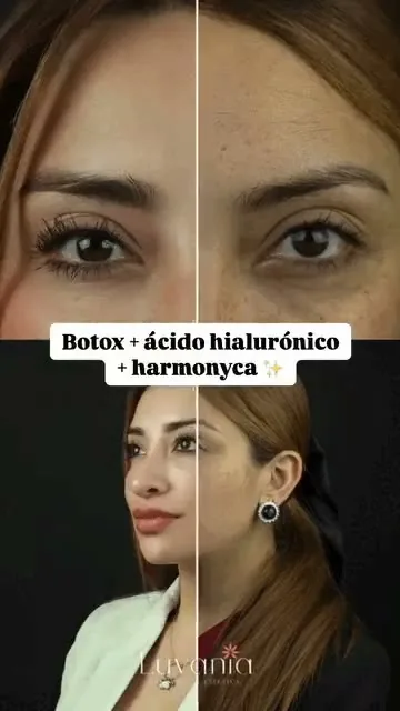 Resultado antes y después de una paciente de Luvania