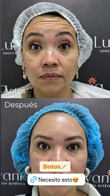 Resultado antes y después de una paciente de Luvania